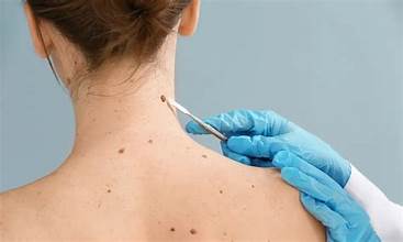 skin tag